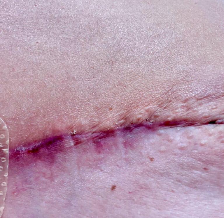 Red inflamed scar after DIEP surgery