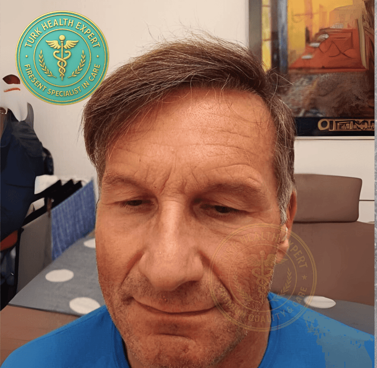 resultat de 1 ans apres la greffe de cheveux pour les seniors de plus de 50 ans