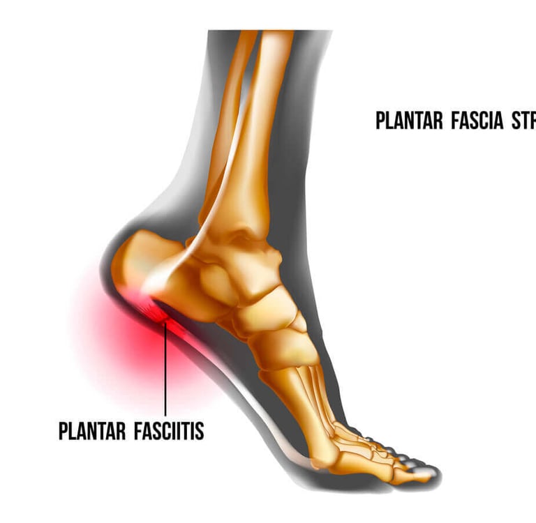 Plantar Fascia