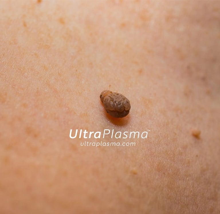 ultraplasma.com_skin_tag_removal_treatment_et_beni_temizleme_silme_tedavi_ultra_plasma_ultra_plazma