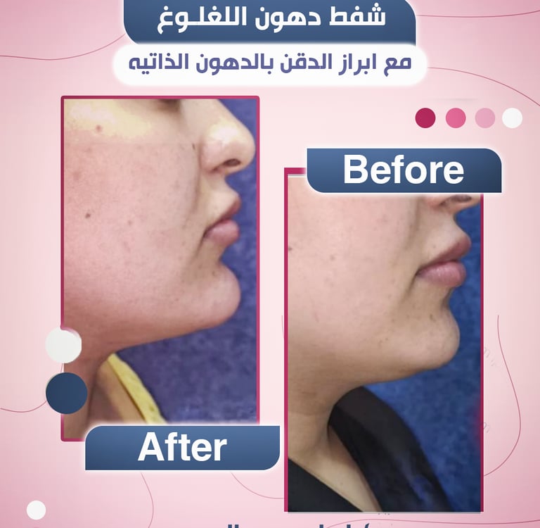 شفط اللغلوغ  مع الدكتور ابراهيم العبد