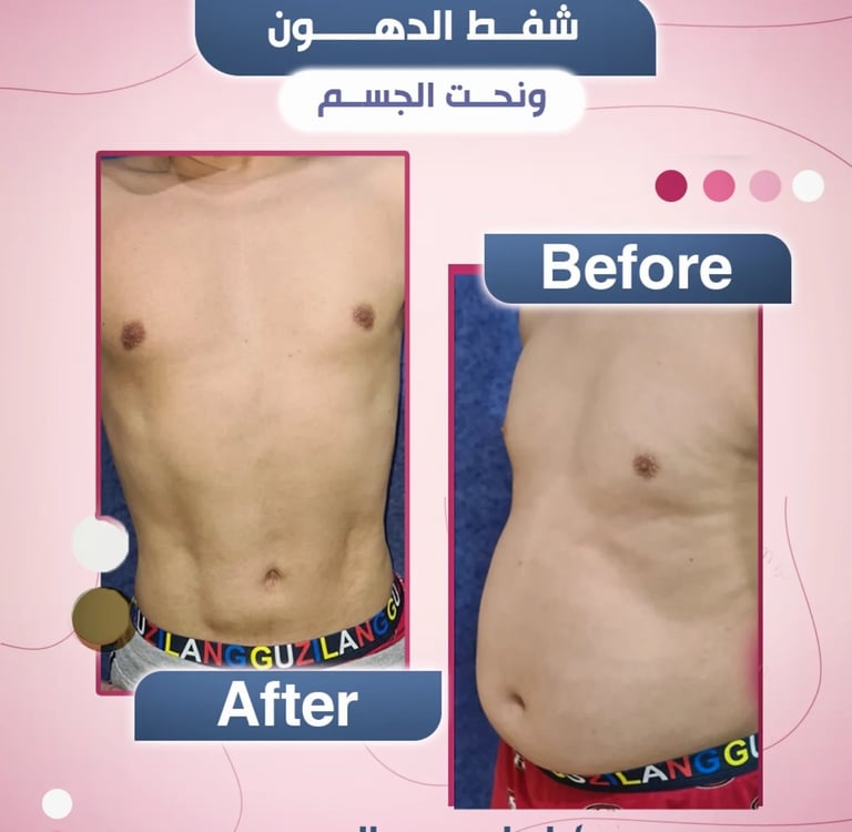 نتيجة شفط وشد البطن مع الاستشاري الدكتور ابراهيم العبد