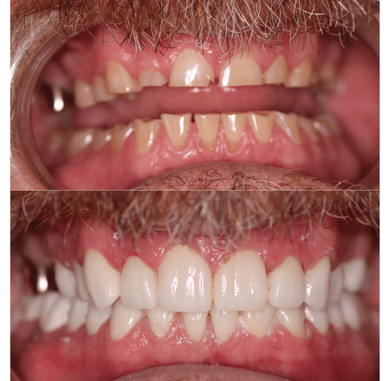 Before and after full mouth rehabilitation 
