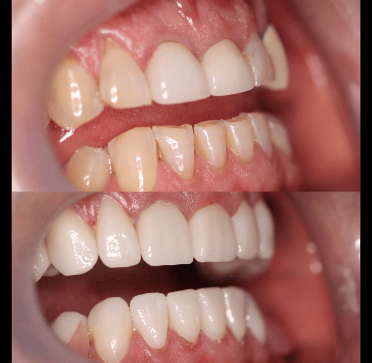 Side view of a before and after full zirconium crowns
