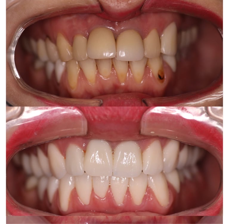 front view of before and after full zirconium crowns