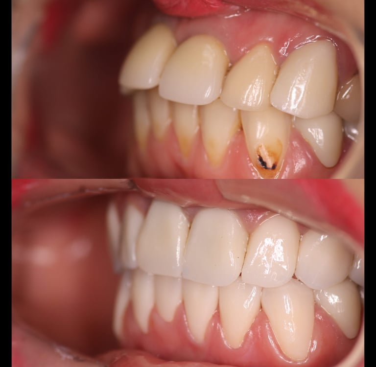 front view of before and after full zirconium crowns