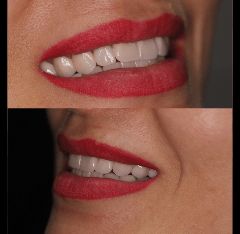 side view of before and after full zirconium crowns