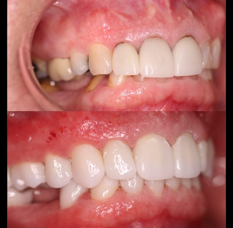 Full Mouth Rehabilitation