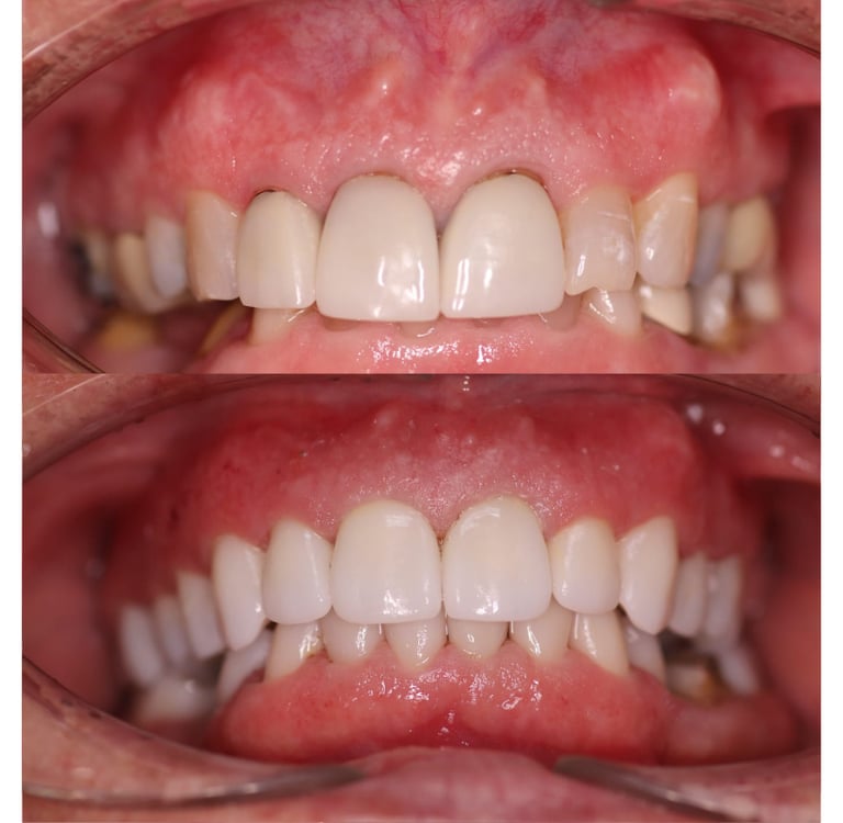 Full Mouth Rehabilitation