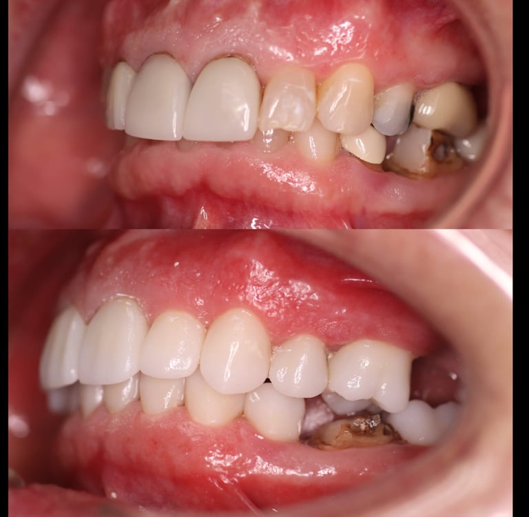 Full Mouth Rehabilitation