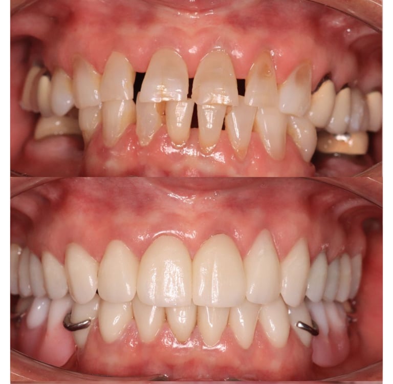 Full Mouth Rehabilitation