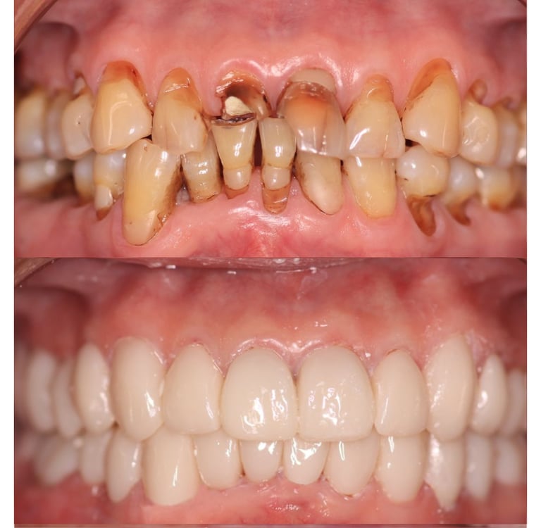 Full Mouth Rehabilitation