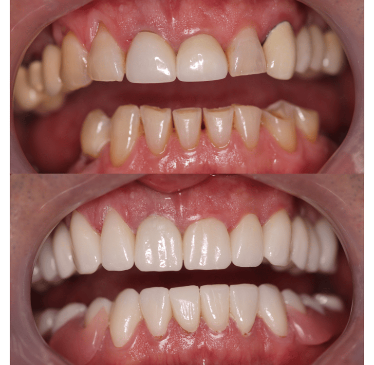 Full Mouth Rehabilitation