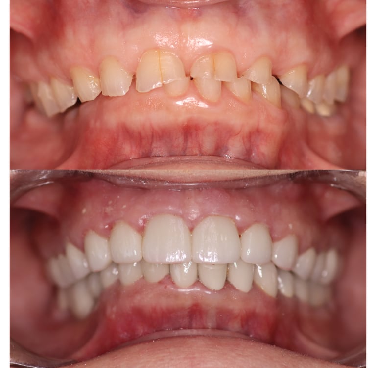 Full Smile Makeover before and after
