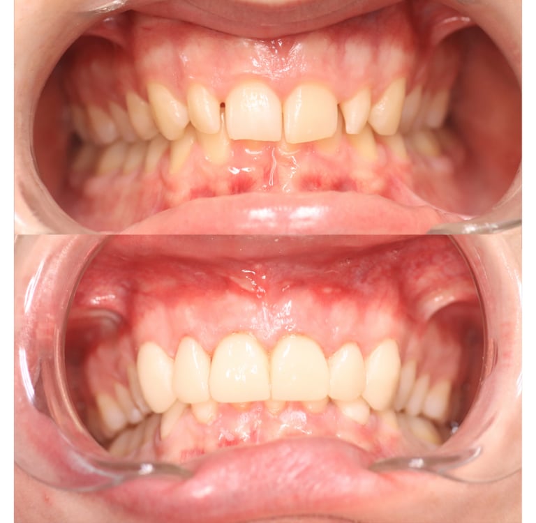 Full Mouth Rehabilitation