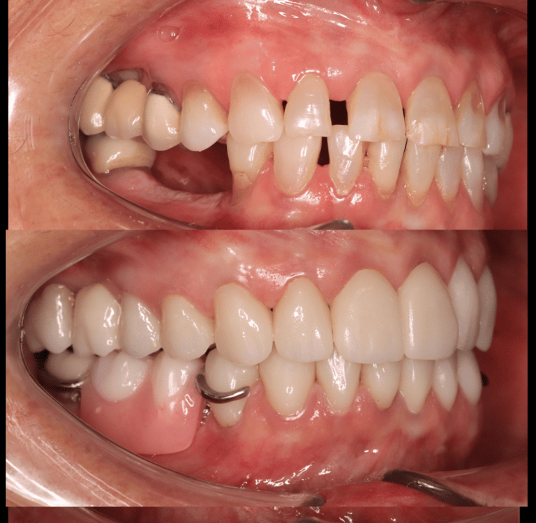 Full Mouth Rehabilitation