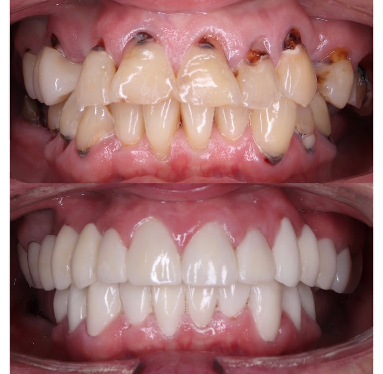 Full Mouth Rehabilitation