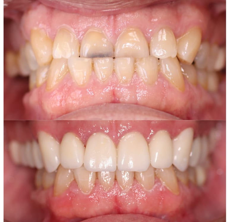 Upper zirconium Crowns
