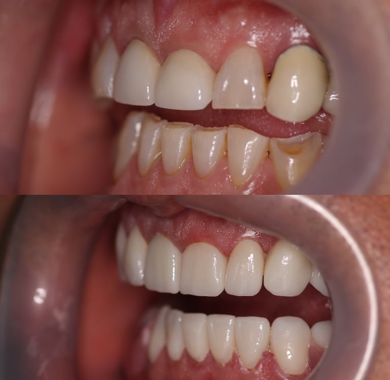 Side view of a before and after full zirconium crowns