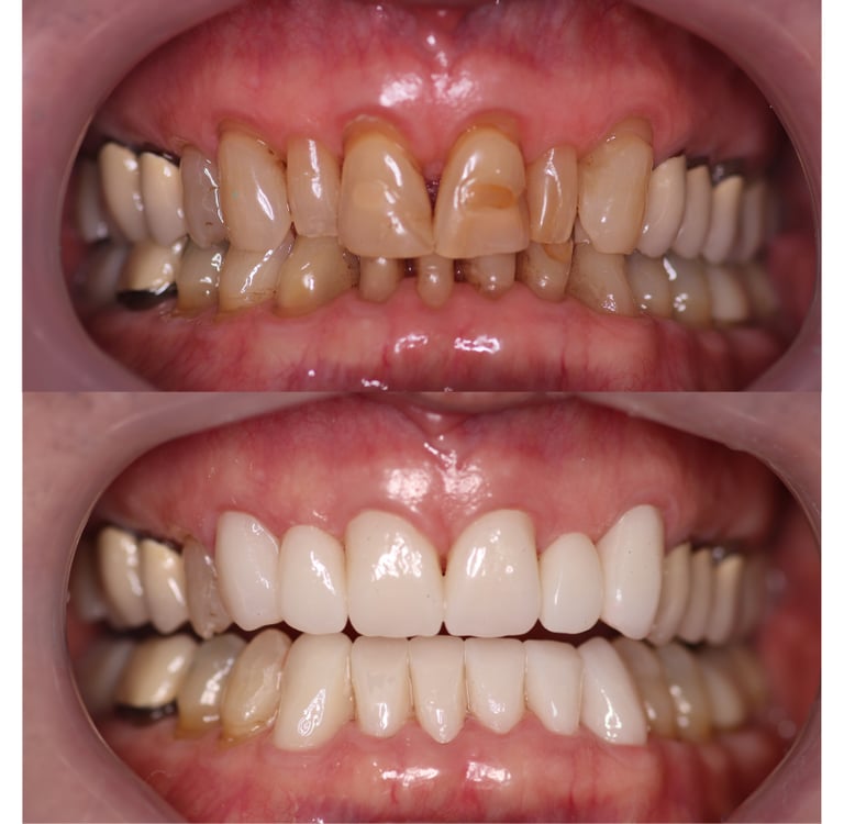 Before and after 12 zirconium crowns
