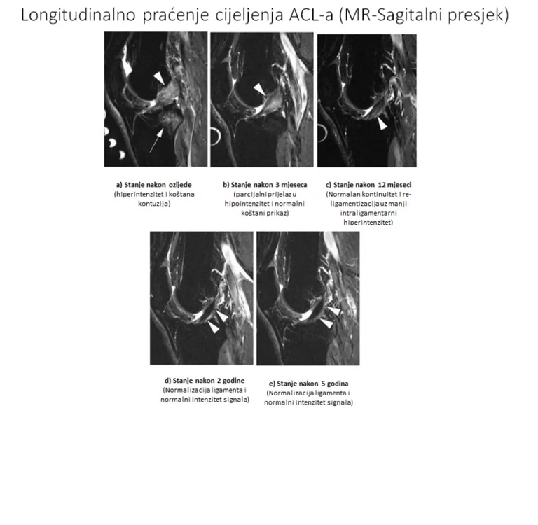 MR prikaz cijeljenja ACL-a kod neoperativne rehabilitacije