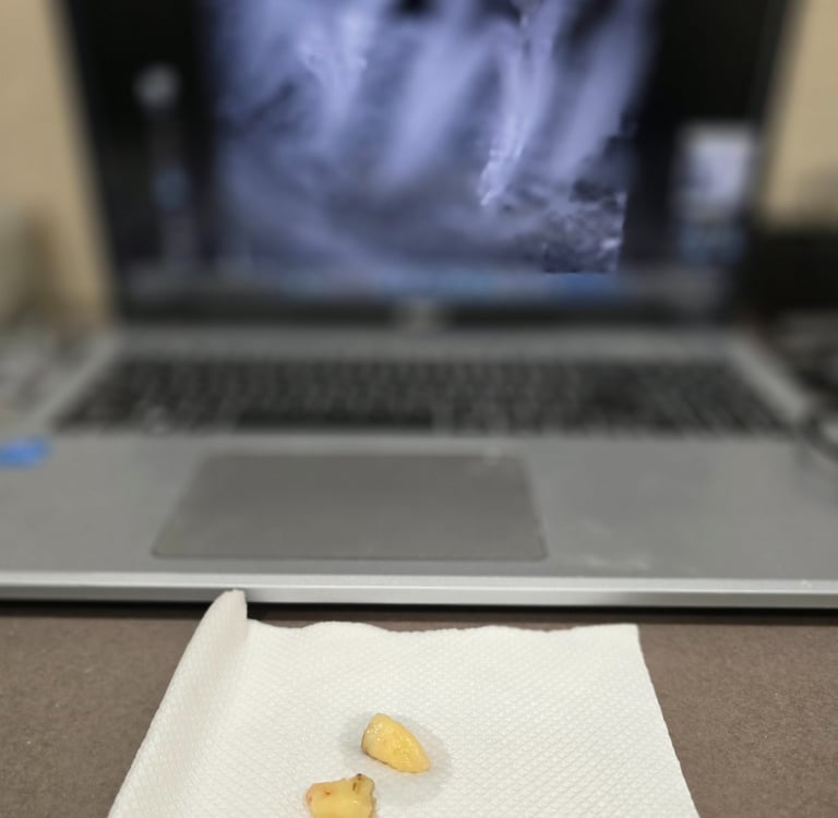 Painless wisdom tooth extraction in Wakad