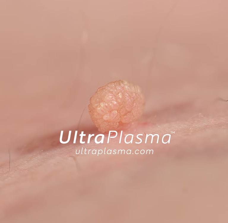 ultraplasma.com_skin_tag_removal_treatment_et_beni_temizleme_silme_tedavi_ultra_plasma_ultra_plazma2