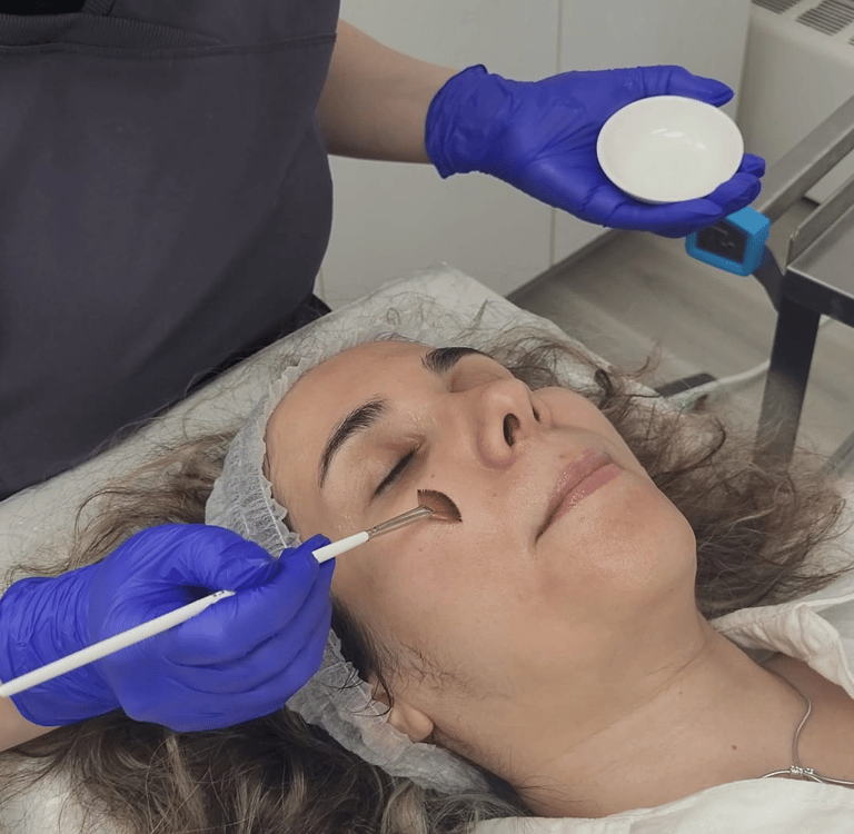 A rejuvenating chemical peel performed on a young client at Ariana Esthetic, Edmonton.