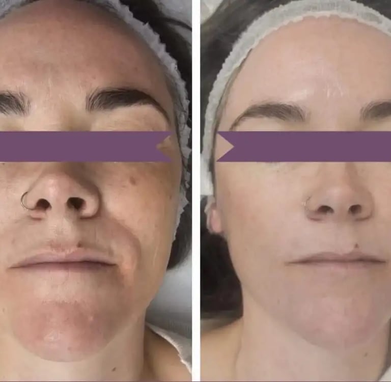 Peeling at Ariana Esthetic Edmonton