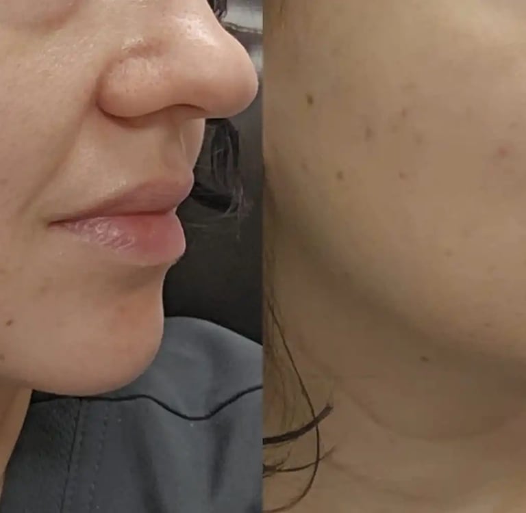 KINVIVE by Juvederm treatment at Ariana Esthetic Edmonton
