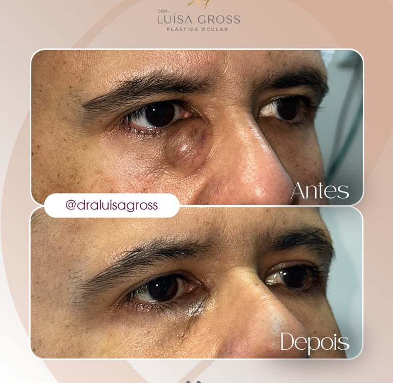 Antes e depois de cirurgia periocular realizada pela Dra. Luisa Gross