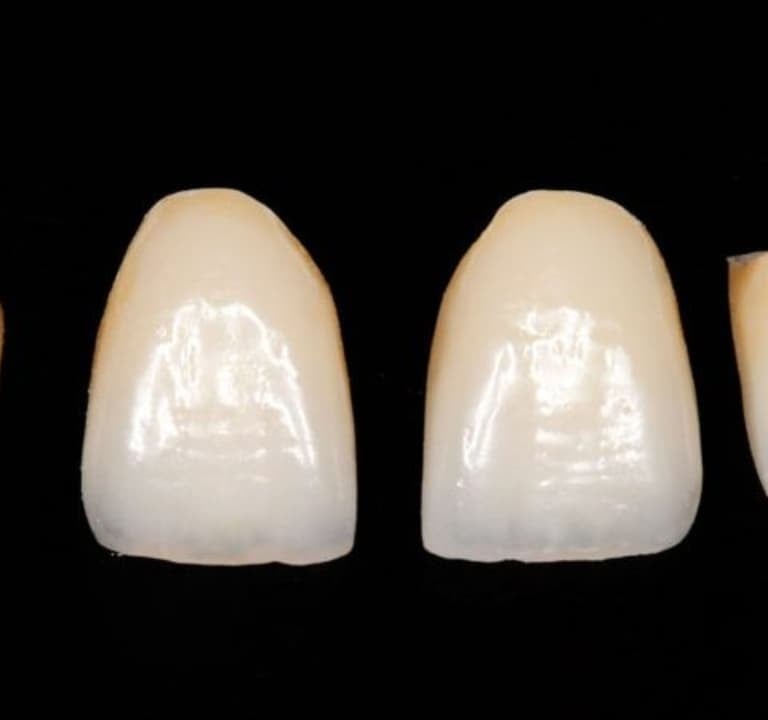 corona dental ceramica