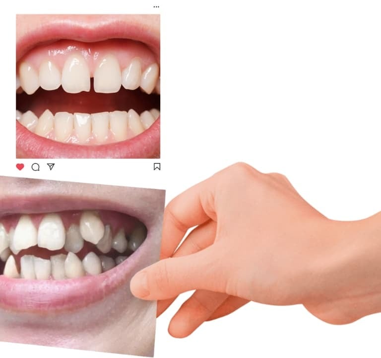 diastema vs apiñamiento