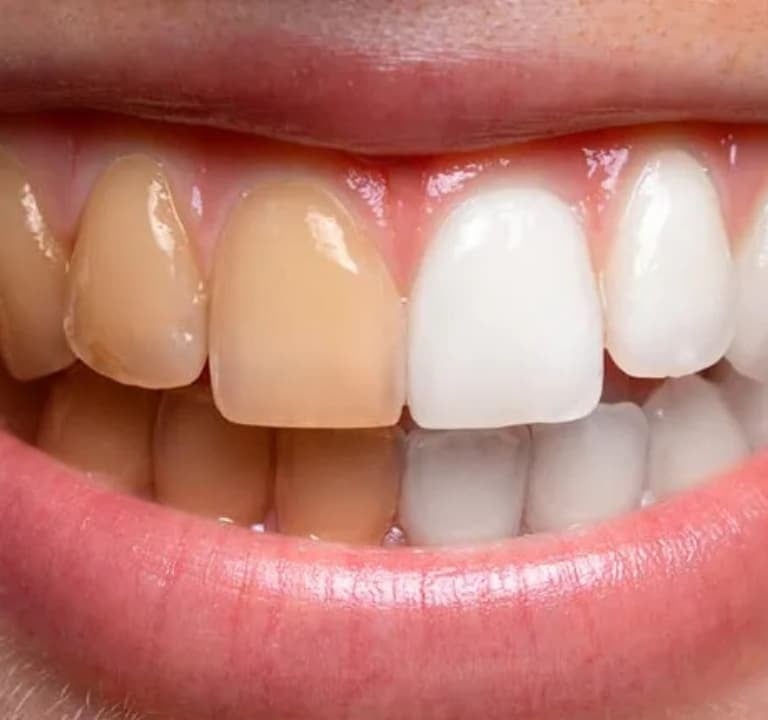 blanqueamiento dental