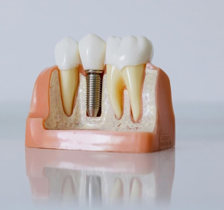 implante dental badajoz