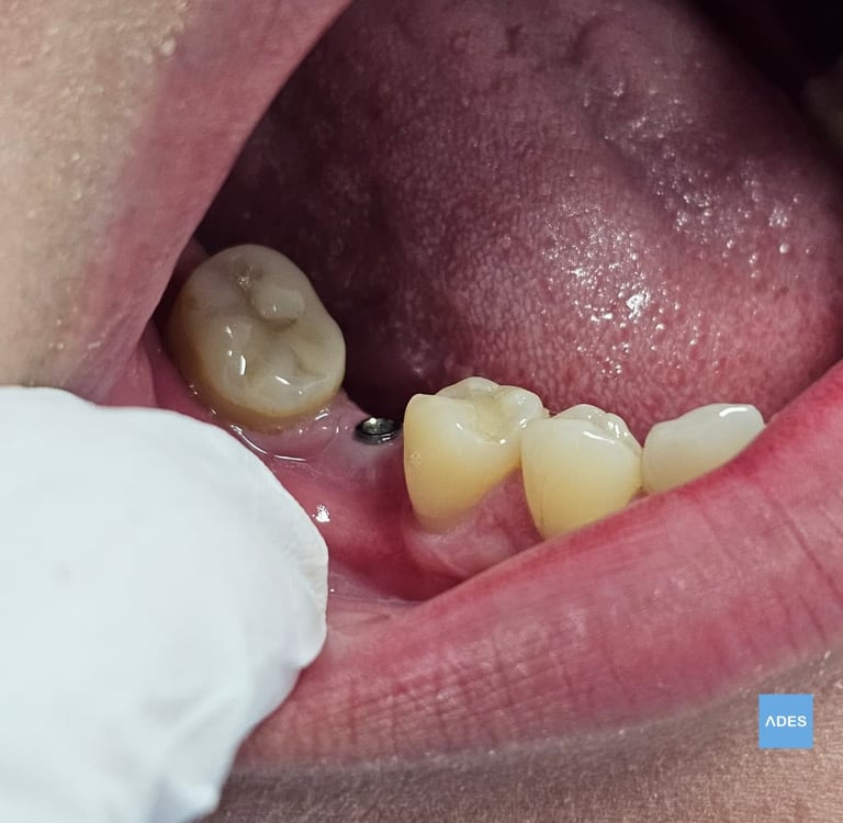 Servicio de implantes en Badajoz