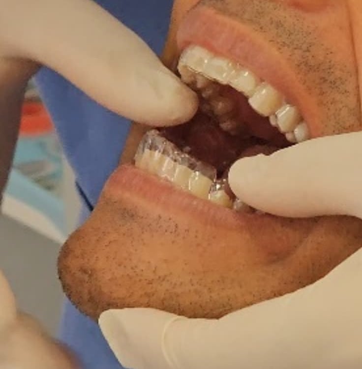 Tratamiento de ortodoncia invisible en Badajoz