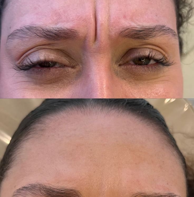 Botoks Ozawor mazowiecki