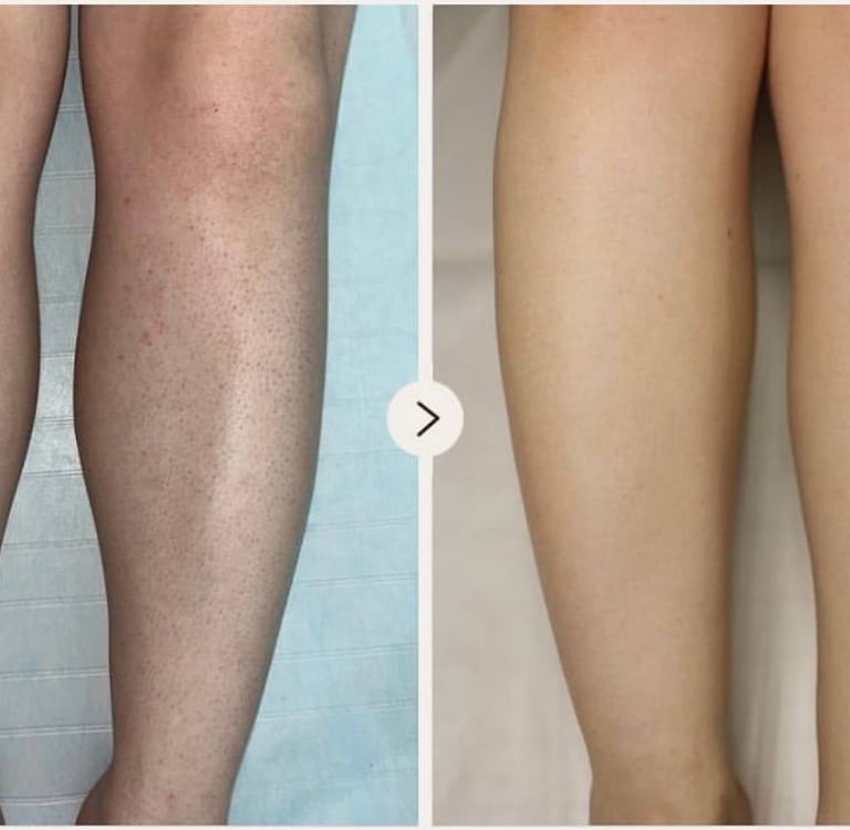 depilacja laserowa komorów