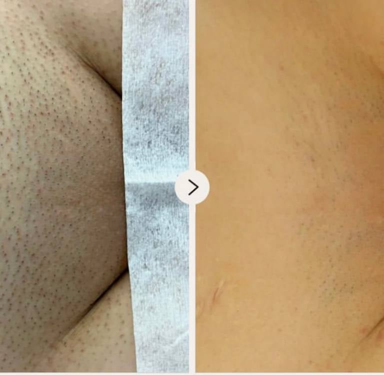 Depilacja laserowa Pruszków 