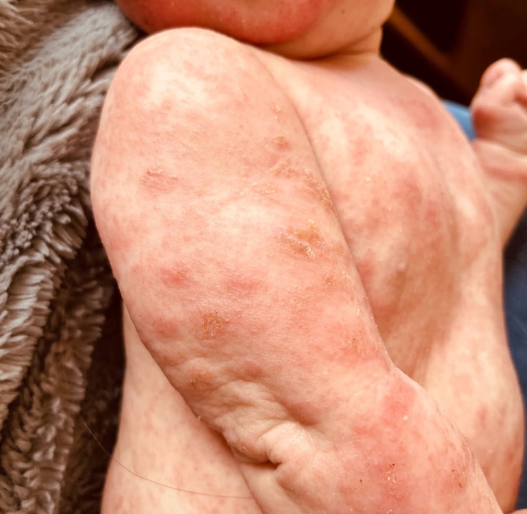 Eczéma présent sur tout le corps d'un bébé avec de grandes plaques