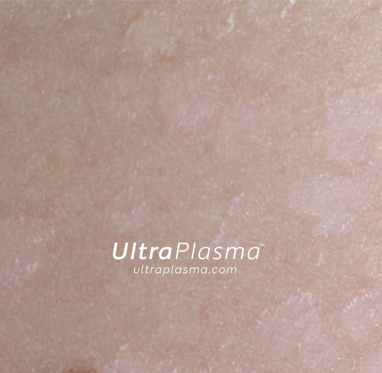 ultraplasma.com_Tinea_Versicolor_treatment_tinea_mantar_tedavi_ultrap_plasma_ultra_plazma