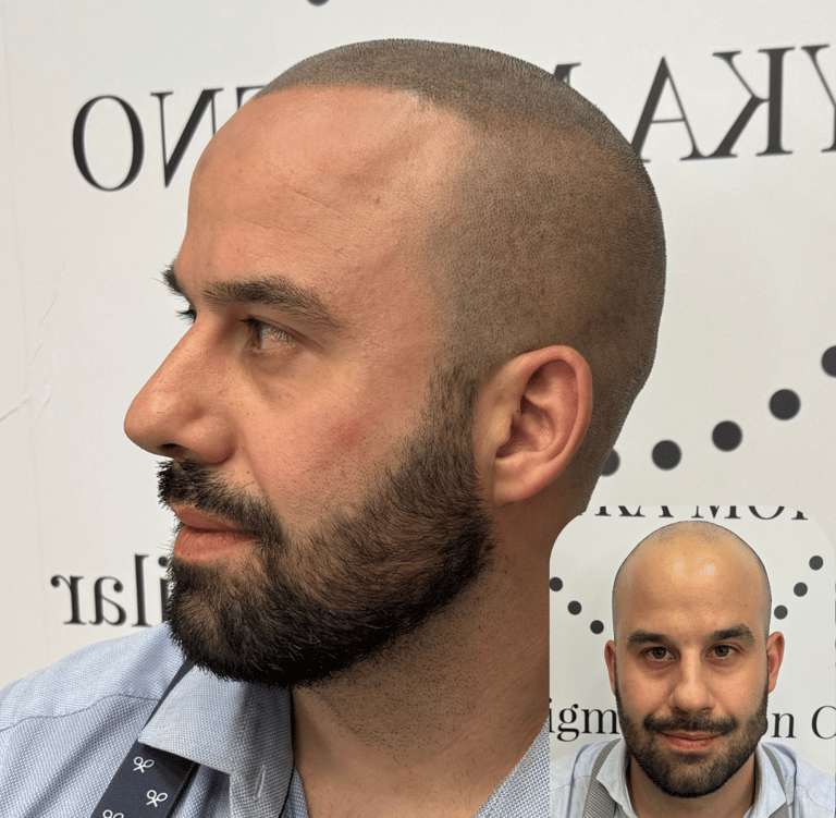 Resultado de micropigmentación capilar en hombre calvo en Madrid, con efecto rapado natural.