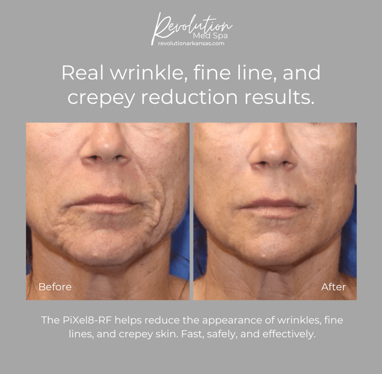 Real wrinkle, fine line, and crepey reduction results.  The Pixel-8 RF microneedling reduces lines.