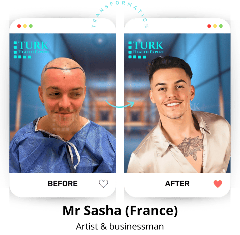 hair transplant before after result