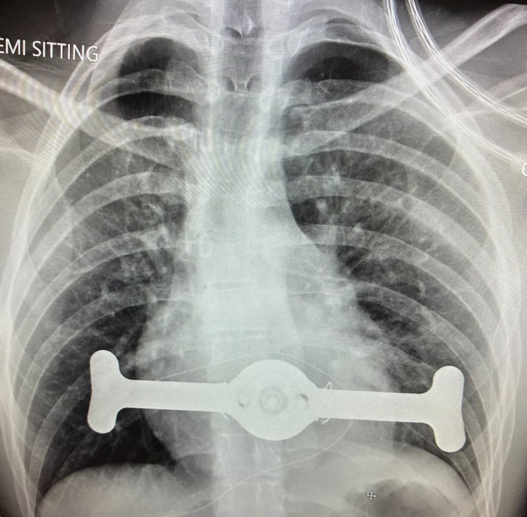 Pectus-Up Operation Malta