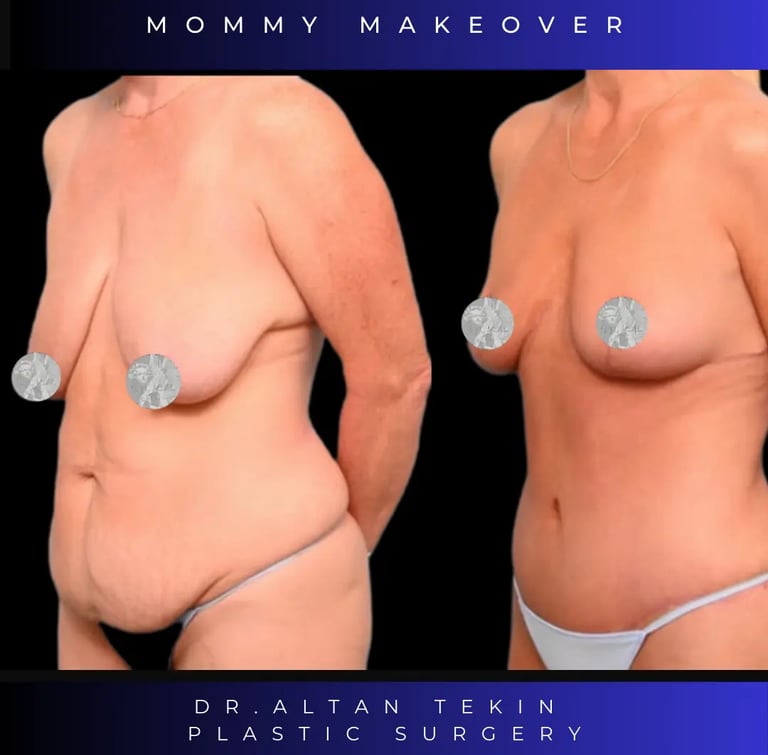 mommy makeover before after photos in Antalya Turkey