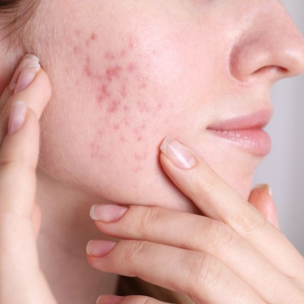 woman with acne