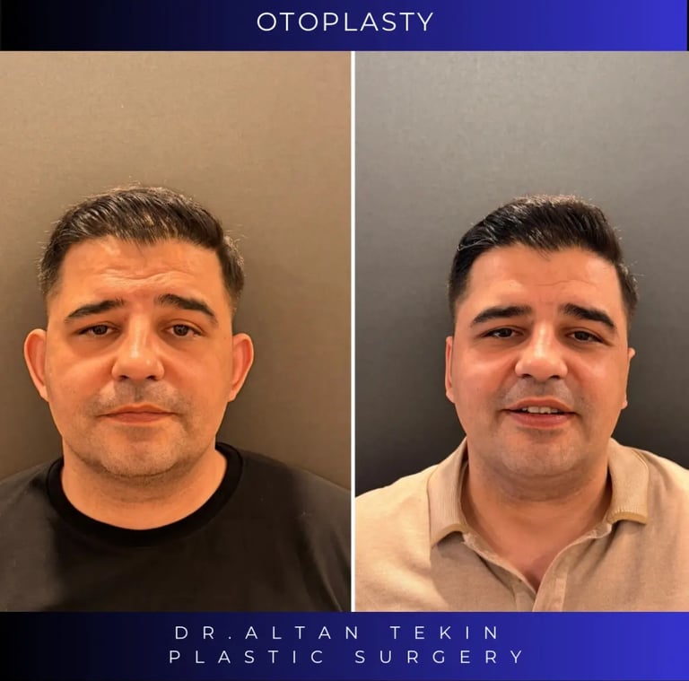 ear correction before after photos in Antalya, Turkey