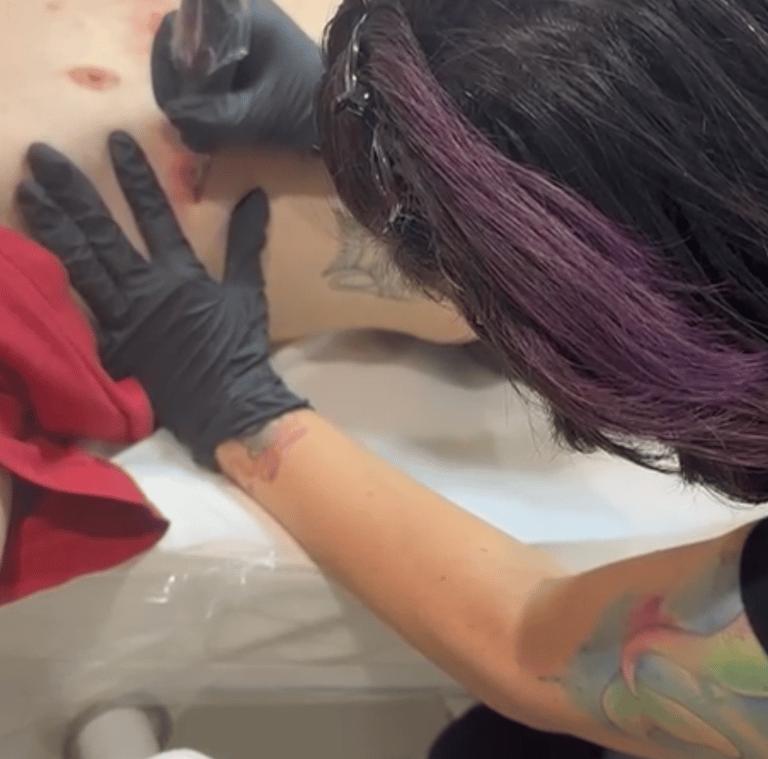 Scar camouflage tattoo procedure